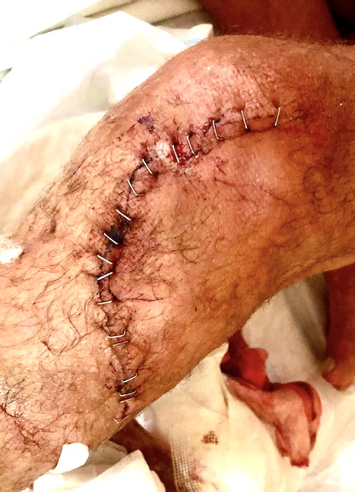 knee-scar