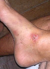 koh-phangan-thailand-eco-tourism-skin-wounds_02072012112