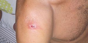 koh-phangan-thailand-eco-tourism-skin-wounds_02072012113